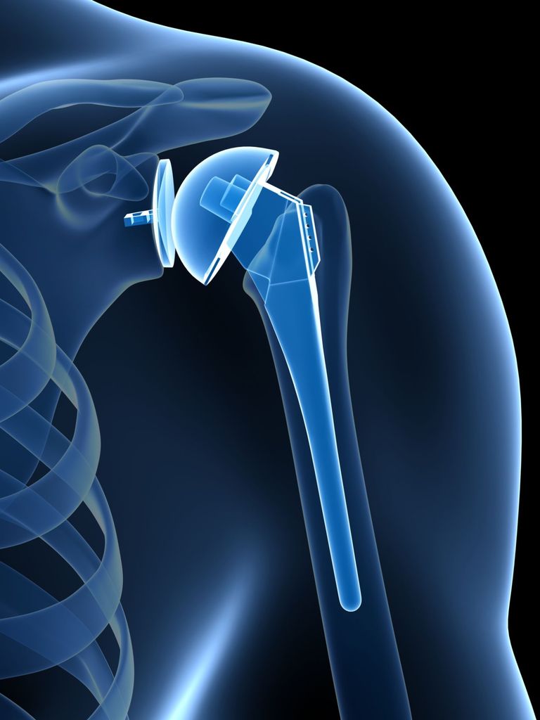 3D endoprosthetics of the shoulder joint in Italy